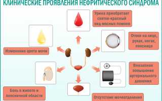 Нефритический синдром отличие от нефротического синдрома