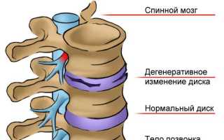 Остеохондроз корешковый синдром симптомы поясничного отдела лечение