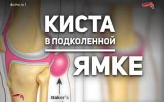 Киста бейкера код по мкб 10 у детей