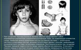 Дети с синдромом тернера фото