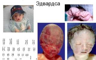 Мозаичная форма синдрома эдвардса что это