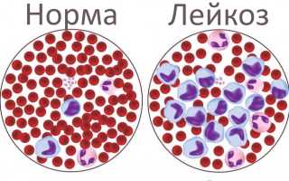 Гиперпластический синдром острого лейкоза у