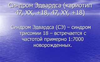 Почему рождаются дети с синдром эдвардса