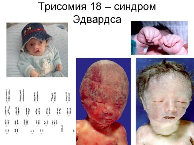 Мозаичная форма синдрома эдвардса что это