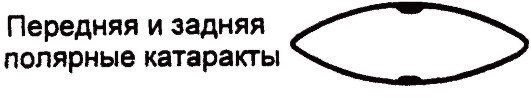   Передняя и задняя полярная катаракта.