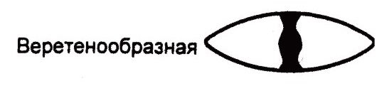 Веретенообразная катаракта