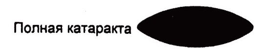 Полная катаракта