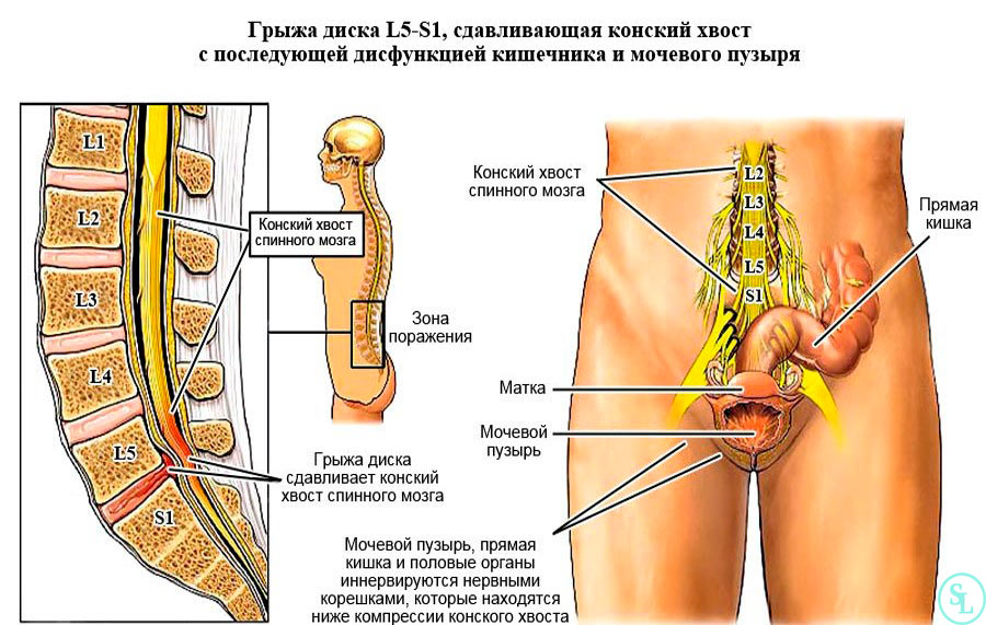 Сдавливание конского хвоста человека