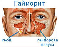 J01.0 Острый верхнечелюстной синусит