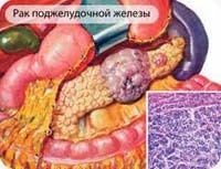 Рак поджелудочной железы