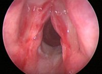 S10.0 Ушиб горла