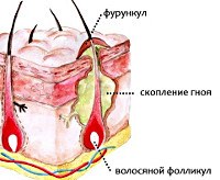 Фурункул носа