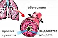 Острый обструктивный бронхит