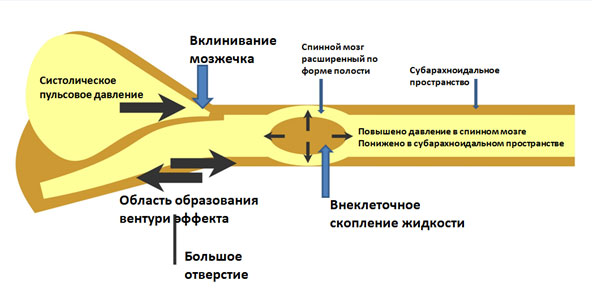 Типичная МРТ-картина Киари подобного порока и сирингомиелии у собак