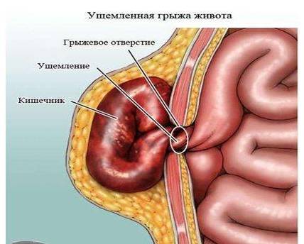 Расширенное пупочное кольцо код по мкб 10