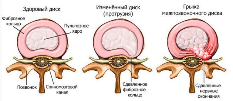Что такое остеохондроз проявление болевые синдромы лечение