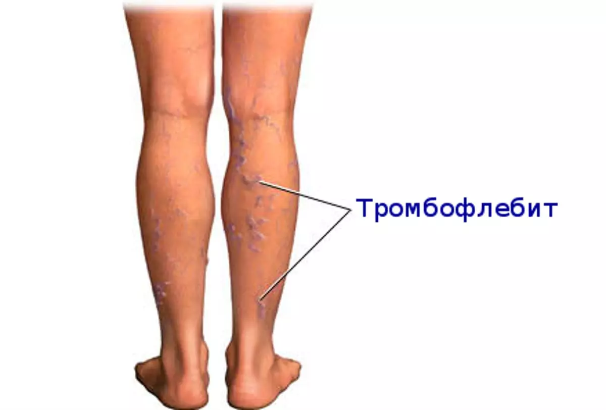 рисунок тромбофлебит