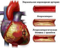 Острый коронарный синдром