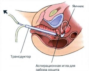 Взятие пункции