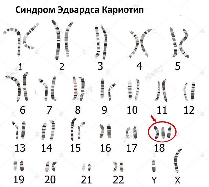 кариотип 18