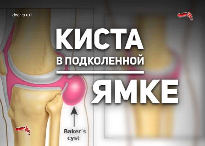 Киста Бейкера (Беккера): что это, какие причины, симптомы, диагностика, методы лечения кисты в подколенной ямке