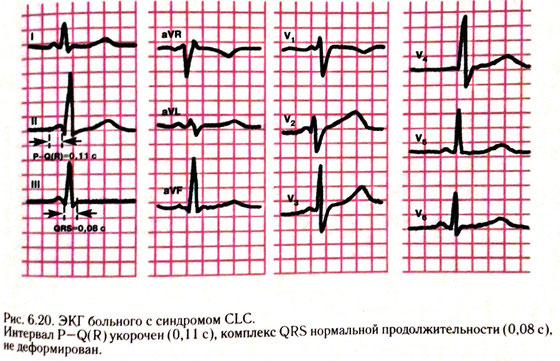 Синдром клерка леви кристеско симптомы