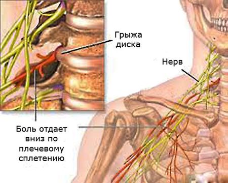 боль при шейном остеохондрозе