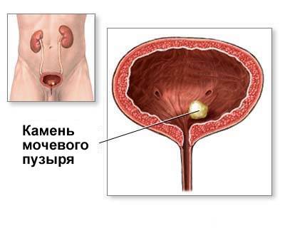 Образование камня мочевого пузыря