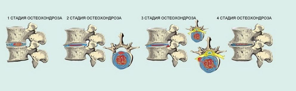 Стадии остеохондроза 