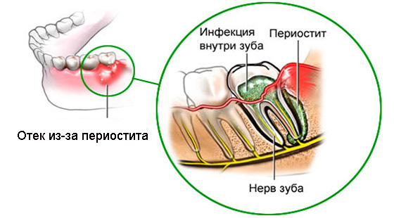 Так выглядит периостит на верхней челюсти