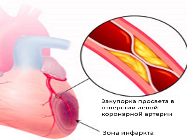 Вследствие этого, в обескровленном участке нарушаются физиологические процессы, накапливаются продукты распада, это приводит к некрозу (отмиранию) 