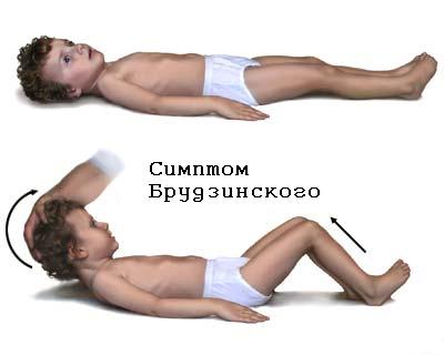 Дифференциальная диагностика менингитов и синдрома менингизма