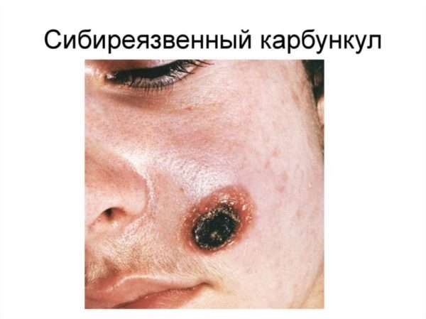 Код мкб 10 абсцесс фурункул