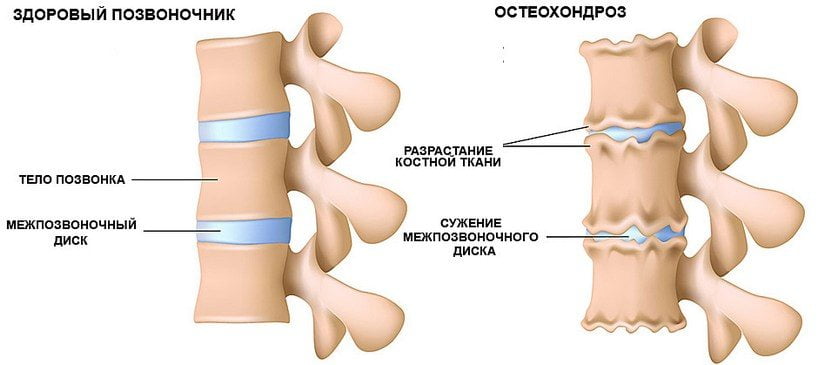 Остеохондроз 