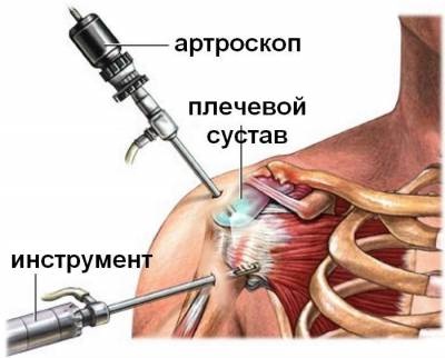акромиопластика используется в запущенных стадиях болезни