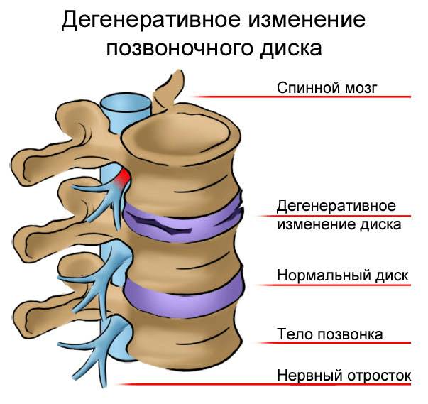 Корешковый синдром