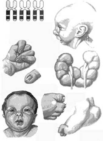 Симптомы при синдроме Эдвардса (трисомия 18)
