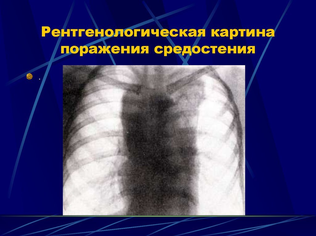 Лимфогранулематоз средостения
