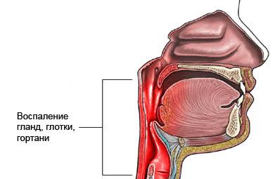 Тонзиллофарингит