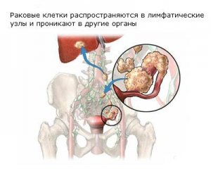 Рак яичников код мкб